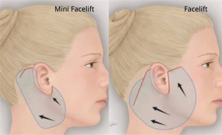 What is mini max procedure?