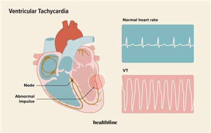 What is the most common cause of ventricular tachycardia?