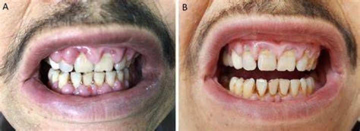 Why does AML cause gum hypertrophy?