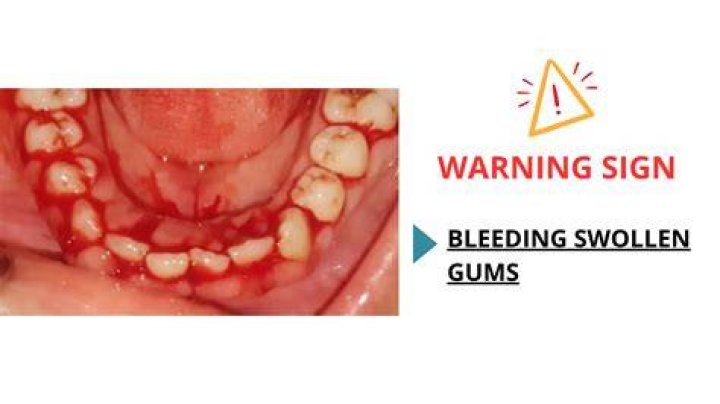 Why gums are swollen in leukemia?